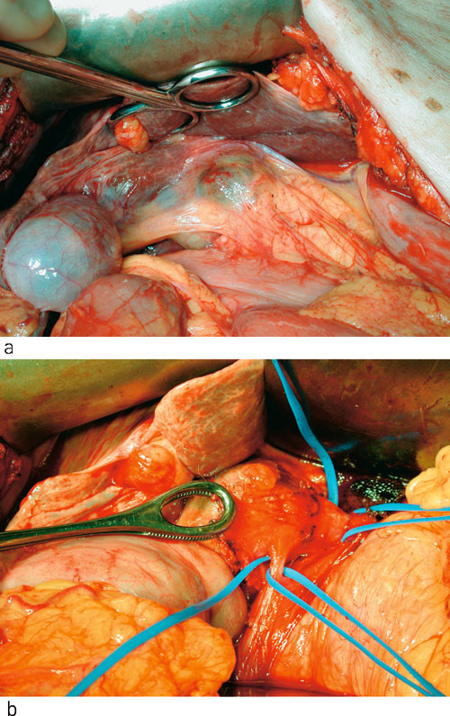 Figur 3  Bilder tatt under operasjonen. a) aneurismet f&oslash;r det ble frilagt, b) aneurismet frilagt med karstrikker p&aring; a&hellip;