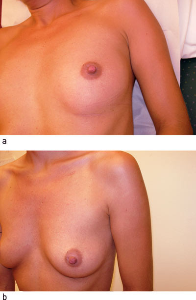 Figur 4  Pacemakerlommen er godt skjult i a) liggende stilling og ikke synlig i b) sittende/st&aring;ende stilling
