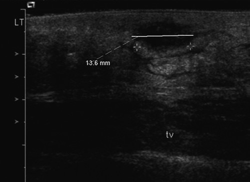 Figur 2  Ultralyd av nedre abdominalvegg: Uregelmessig lavekkogen lesjon beliggende 3 mm subkutant, ca. 14 mm i st&oslash;rste&hellip;