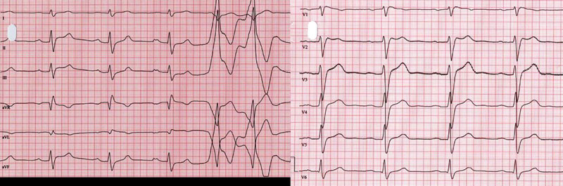 Figur 2  EKG (50 mm/s) av pasienten i forbindelse med aktuelle unders&oslash;kelse. Her er registreringen best forenlig med type 2&hellip;