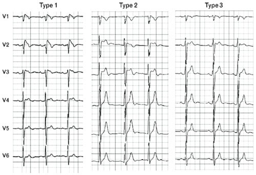 Figur 3  Eksempler (25 mm/s) p&aring; de tre forskjellige typene EKG-morfologi (4)