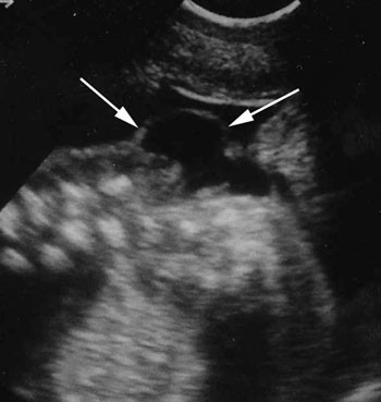 Bilete av spina bifida, lengdesnitt, fosteralder 18 veker. Pilene peikar p&aring; sj&oslash;lve myelomeningocelet. Foto Nasjonalt senter&hellip;