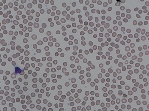 Figur 2  Akantocytter i perifert blod fra pasienten, karakteristisk for chorioakantocytose