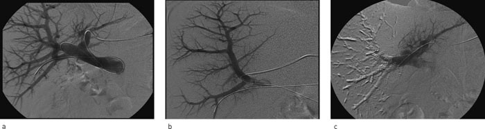 Figur 2  a) Guidewire og kateter er plassert ved perkutan teknikk i portvenesystemet. b) Begynnende deponering av histakryl&hellip;
