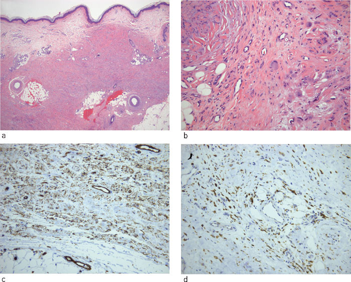 Figur 2 a) Cellerik dermis og subcutis med &oslash;kt bindevevsdanning. b) Utvidede septa med &oslash;kt bindevev og spredte sm&aring;&hellip;