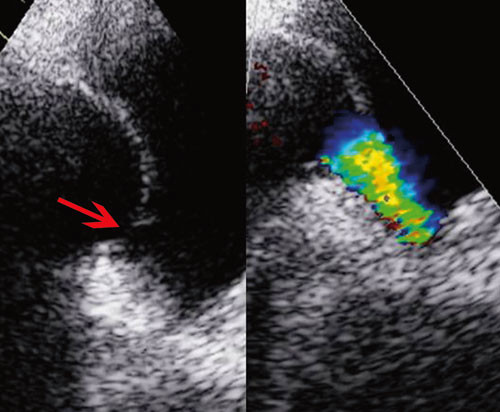 Figur 2 Trans&oslash;sofageale stillbilder viser stort foramen ovale (pil) med str&oslash;m mellom h&oslash;yre og venstre atrium