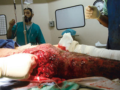 Sv&aelig;r sprengningsskade