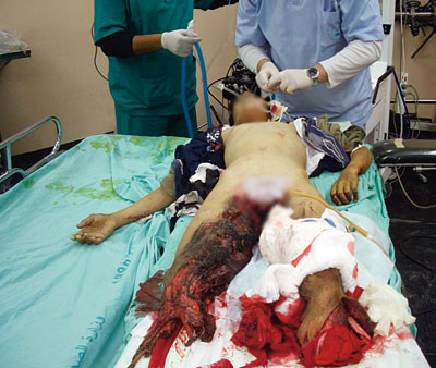 D&oslash;delig skade etter rakettangrep, 15 &aring;r