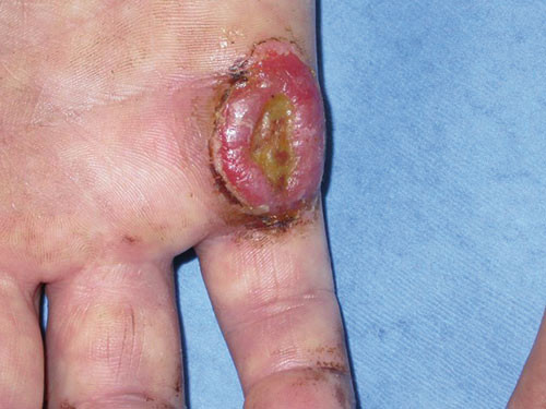 Figur 2  Pasient 1. Ulcerasjon volart 5. MPC-ledd p&aring; h&oslash;yre h&aring;nd