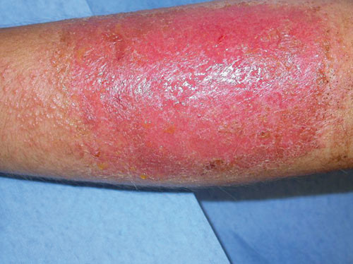 Figur 3  Pasient 1. Hissig erytem og v&aelig;sking p&aring; venstre underarm