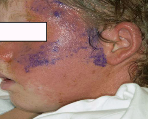 Figur 4  Pasient 2. V&aelig;skende eksem i venstre ansiktshalvdel. Pasientens p&aring;r&oslash;rende har gitt samtykke til at bildene blir&hellip;