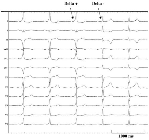 Figur 4  Klassisk Wolff-Parkinson-Whites syndrom. Preeksitasjon (deltab&oslash;lge) som forsvinner under ablasjon samtidig som QRS&hellip;