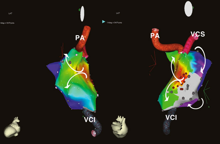 Figur 5  Elektroanatomisk bilde under atrieflutter fra Fontan-korrigert hjerte i venstre bakre skr&aring;projeksjon (til venstre)&hellip;