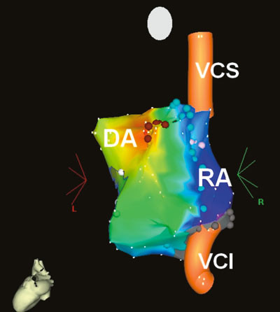 Figur 6  Elektroanatomisk bilde fra hjertetransplantert pasient (venstre bakre skr&aring;projeksjon). Fokal atrietakykardi oppsto&hellip;