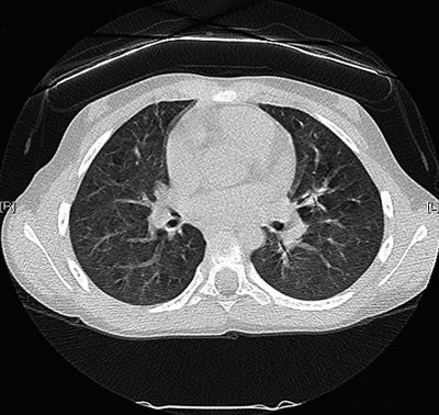 Figur 5  H&oslash;yoppl&oslash;snings-CT av jente med bruk av vismutskjold over brystene
