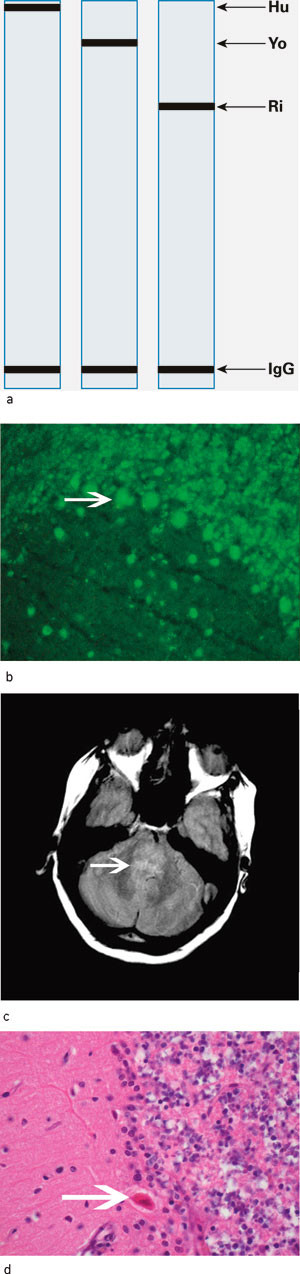Figur 2  Diagnostikk ved paraneoplastiske nevrologiske syndromer. a) Serum fra pasienter med nevronantistoffer viser b&aring;nd&hellip;