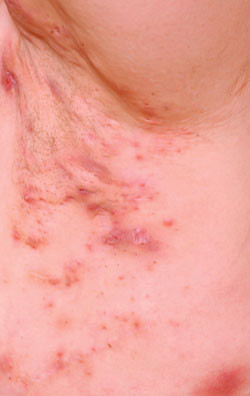 Figur 3  Hidradenitis suppurativa med inflammerte noduler, fistler og markert hypertrofisk arrdanning (Hurleys grad 3)