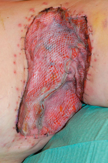 Figur 5  Fem dager etter eksisjon av det affiserte omr&aring;det. S&aring;ret er dekket med delhudstransplantat