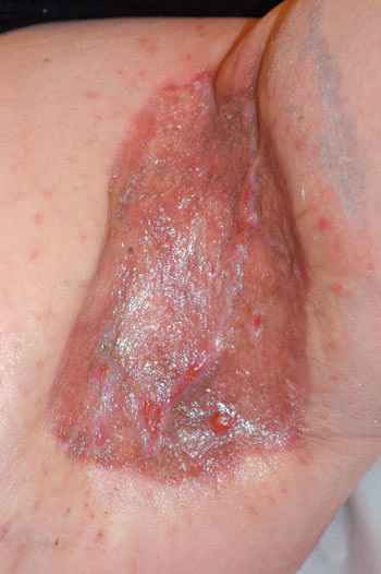 Figur 6  E n m&aring;ned etter operasjonen