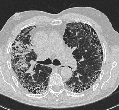 Figur 2  CT thorax. Funn forenlig med generell lungefibrose
