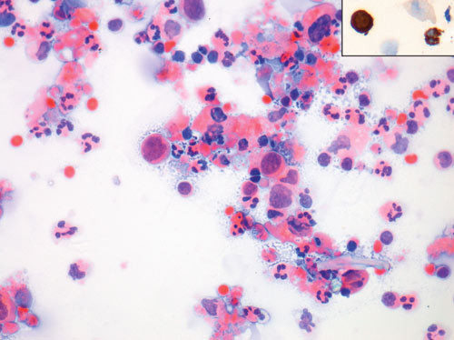 Figur 3  Atypiske celler i spinalv&aelig;sken, innfelt med pancytokeratinfarging