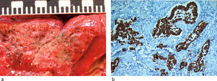 Figur 4  a) Lunge, makroskopisk. Arraktig fibrose i h&oslash;yre lunge. b) Lunge, mikroskopisk, pancytokeratinfarging. Snittflate&hellip;