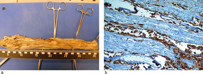 Figur 5  a) Cauda, makroskopisk. Intet synlig patologisk. b) Cauda, mikroskopisk, pancytokeratinfarging. Diffus infiltrasjon&hellip;