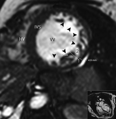 Figur 3  Magnetisk resonanstomografi av hjertet. Endediastolisk tverraksesnitt av venstre (VV) og h&oslash;yre (HV) ventrikkel&hellip;