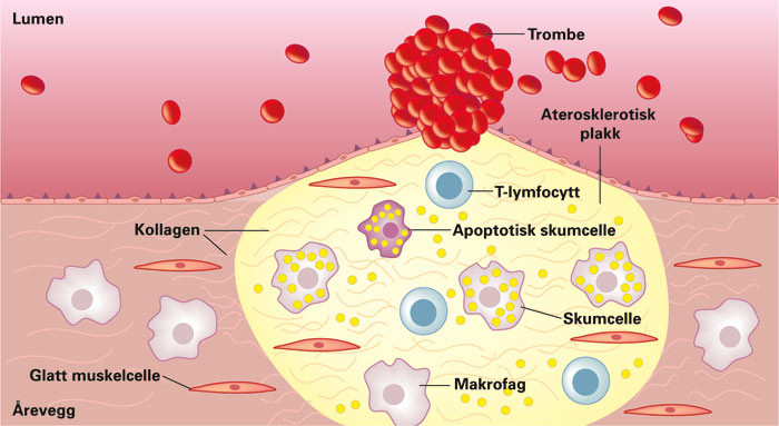 Figur 2  Skjematisk tegning av et &laquo;ustabilt plakk&raquo; med ruptur og trombose. Skumceller akkumuleres i den fibr&oslash;se kappen av et&hellip;