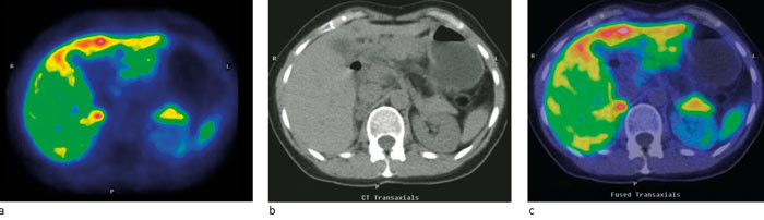Figur 2  HED-PET. a) PET, b) Lavdose CT, c) Fusjonert PET/CT. Pasient med symptomer og biokjemiske holdepunkter for&hellip;