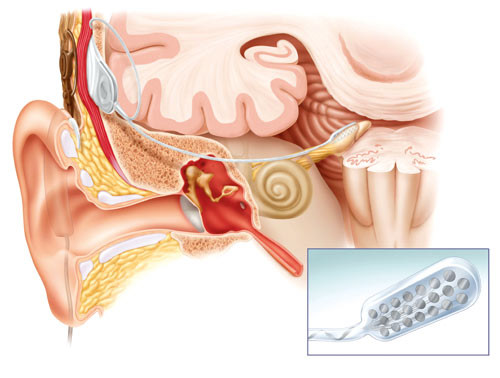 Figur 5  Figuren viser et auditorisk hjernestammeimplantat med en ekstern mikrofon festet bak &oslash;ret, en subkutan&hellip;