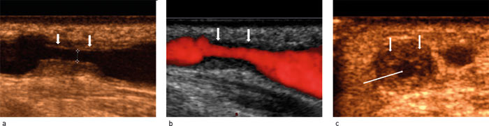 Figur 2  Signifikant stenose p&aring; fistelvenen lokalisert 3 cm fra anastomosen, med diameter av lumen i stenosen m&aring;lt til 1,4&hellip;