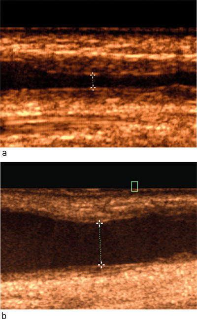 Figur 3  a) Ultralydbilde av h&oslash;ygradig stenose p&aring; fistelvenen, f&oslash;r PTA og med diameter av lumen m&aring;lt til 1,1 mm, og b) etter&hellip;