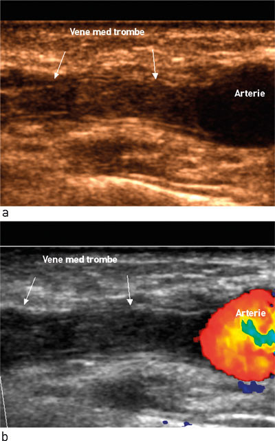 Figur 4  Trombe i fistelvenen hos pasient med plutselig &laquo;taus&raquo; fistel. Med ultralyd p&aring;vist okkluderende trombe i venen &hellip;