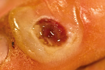 Figur 2  Kryoprosedyren etterlet eit krater