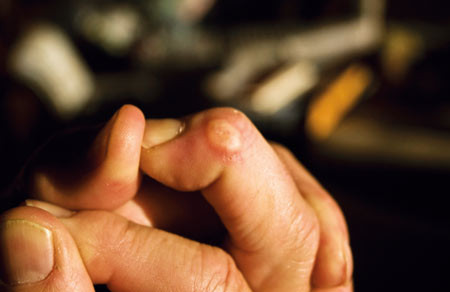 Figur 3  Kort etter epitaliseringa residiverte cysten