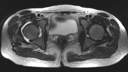 Figur 2  MR viser hydrops i h&oslash;yre hofteledd og oppladning i fortykket synovia, som ved synovitt eller artritt. Mistanke om&hellip;