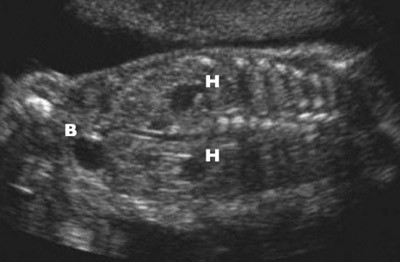 Figur 2  Lett dobbeltsidig hydronefrose hos foster (H). Merk fylling av urinbl&aelig;ren (B). Foto Lars Johansen, Kvinneklinikken,&hellip;