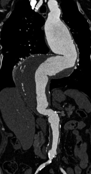 Figur 2  CT-unders&oslash;kelse med kontrast som fremstiller et torakoabdominalt aortaaneurisme. Denne pasienten hadde tidligere&hellip;