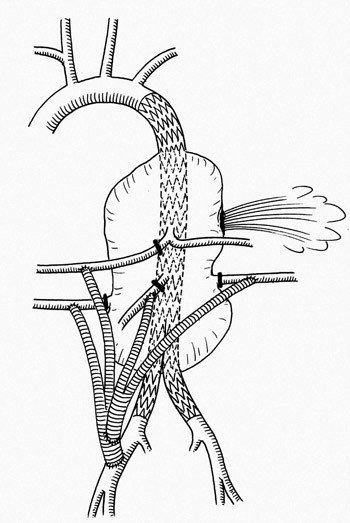Figur 5  Skjematisk fremstilling av en hybridoperasjon hos en pasient som ble innlagt med rumpert torakoabdominalt&hellip;