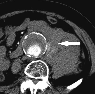 Figur 2  CT-aksialbilde av abdomen med aortaaneurisme med ruptur (pil), p&aring;g&aring;ende bl&oslash;dning og hematom. Foto Billeddiagnostisk&hellip;