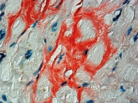 Figur 2  Endomyokardial biopsi. Snittet er farget med kongor&oslash;dt og viser nedslag av amyloid mellom myocyttene