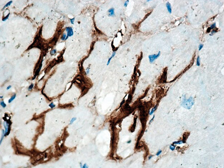 Figur 3  Endomyokardial biopsi. Immunhistokjemisk behandling med antistoffer rettet mot transtyretin viser ekstracellul&aelig;r&hellip;