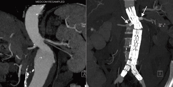 Figur 2  Aneurisme med kort hals, f&oslash;r og etter innsettelse av fenestrert tranplantat. Festesonen er forlenget ved &aring; lage&hellip;