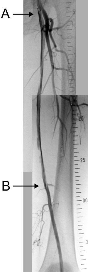 Figur 2  Bildet viser en typisk subintimal kanal i arteria femoralis superficialis som her er rekanalisert fra lysken (a)&hellip;