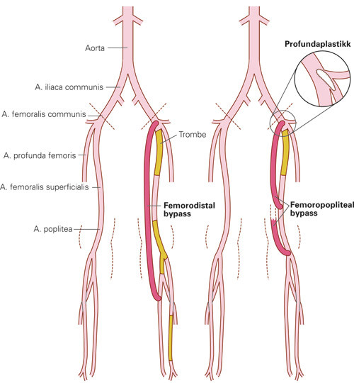 Figur 3  Figuren viser karkirurgiske behandlingsalternativer ved aterosklerose distalt for lyskeb&aring;ndet. Profundaplastikk er&hellip;
