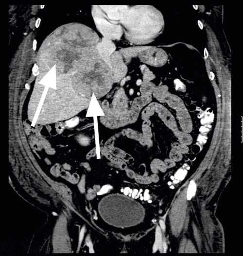 Figur 2  CT-unders&oslash;kelse av abdomen viste to tumorer i lever