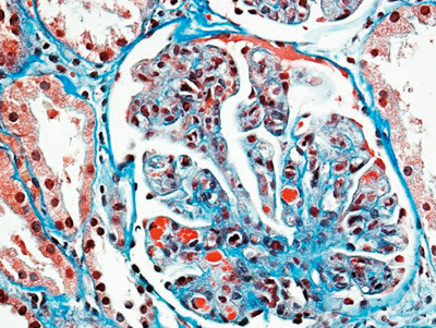 Figur 2  Nyrebiopsi med mikrotromber (r&oslash;dt materiale)