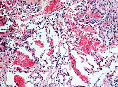 Figur 3  Lungebiopsi med utbredt bl&oslash;dning, men ikke p&aring;vist kapillaritt