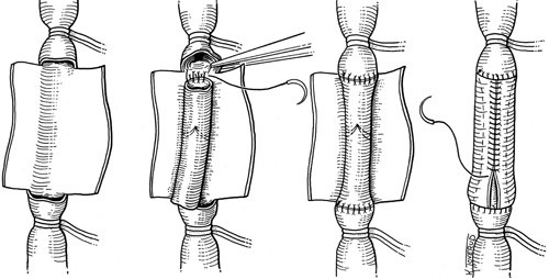 Figur 3  Transplantasjon: Et venesegment med en normalt fungerende veneklaff transplanteres til en insuffisient dyp vene&hellip;